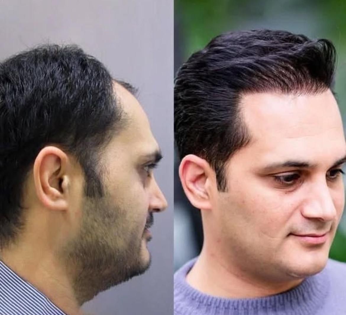 کاشت مو و‌یک جلسه مزوتراپی یک جلسه پی آر پی رایگان|خدمات آرایشگری و زیبایی|تهران, جردن|دیوار