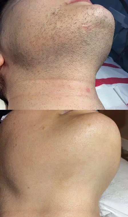 لیزر موهای زائد با دستگاه الکساندرایت کندلا (شاتی)|خدمات آرایشگری و زیبایی|قزوین, |دیوار
