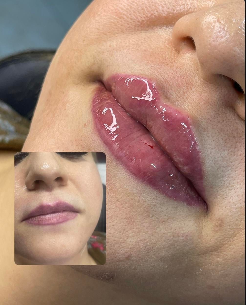 ژل لب تزریق ژل بوتاکس ژل گونه چانه زاویه فک|خدمات آرایشگری و زیبایی|اصفهان, سعادت‌آباد|دیوار