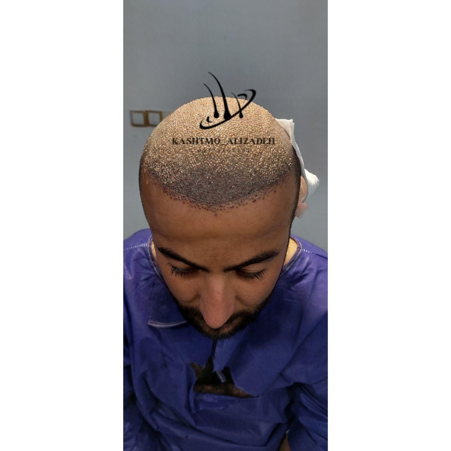 کاشت شیرازی موی سر و ابرو در ارومیه به مدت کوتاه|خدمات آرایشگری و زیبایی|ارومیه, |دیوار