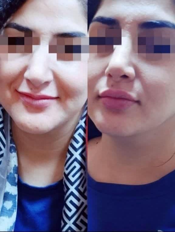 تزریق ژل لب.گونه.چانه.زاویه سازی فک.آنزیم بینی|خدمات آرایشگری و زیبایی|اردکان, |دیوار