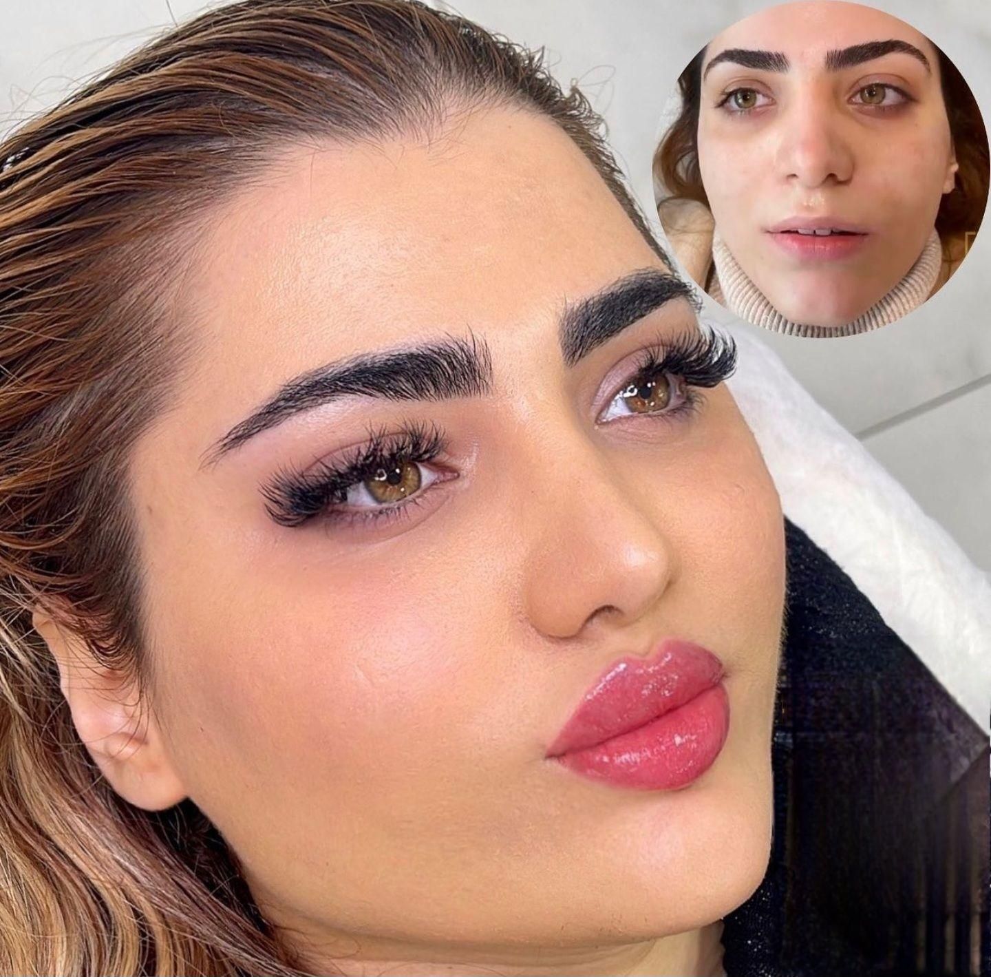 تزریق چربی، ژل وبوتاکس ومادلینگ صورت توسط پزشک|خدمات آرایشگری و زیبایی|کرمانشاه, |دیوار