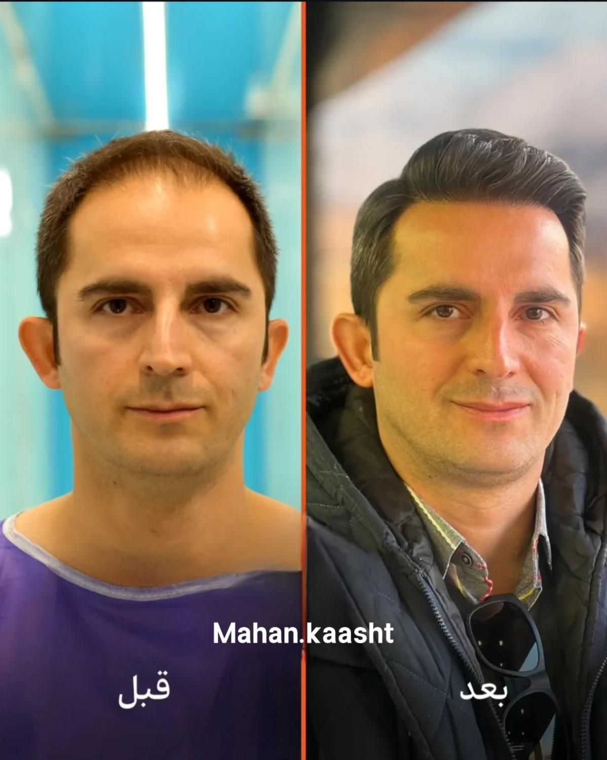 کاشت مو و ابرو اقساطی حتی با سفته|خدمات آرایشگری و زیبایی|مشهد, وکیل‌آباد|دیوار