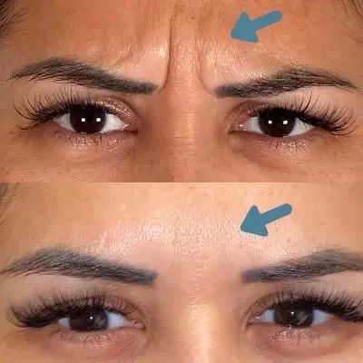 خدمات تخصصی بوتاکس و فیلر در منزل (پزشک مجرب)|خدمات آرایشگری و زیبایی|تهران, اباذر|دیوار
