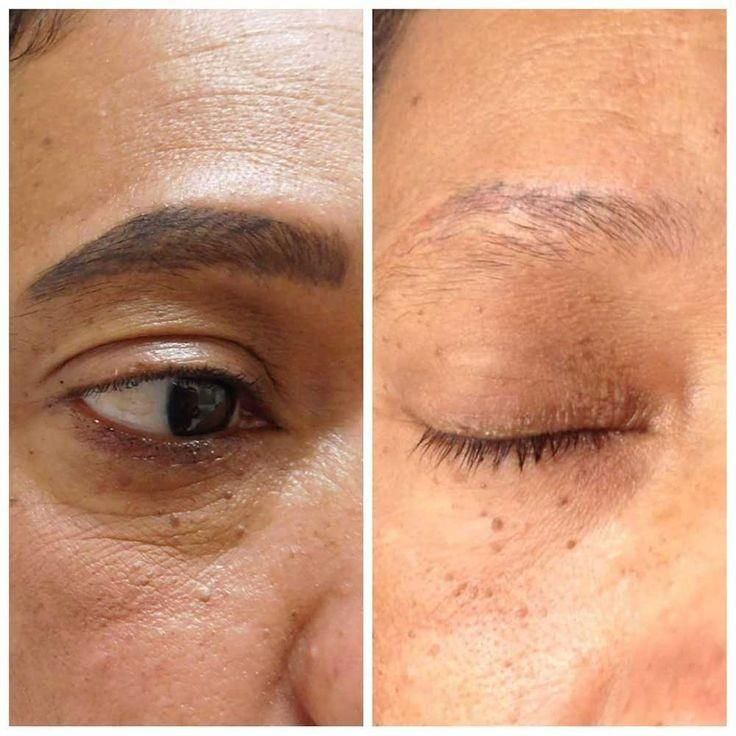 پاک کردن تتو ابرو و بدن با دستگاه لیزر پیکوشور|خدمات آرایشگری و زیبایی|ارومیه, |دیوار