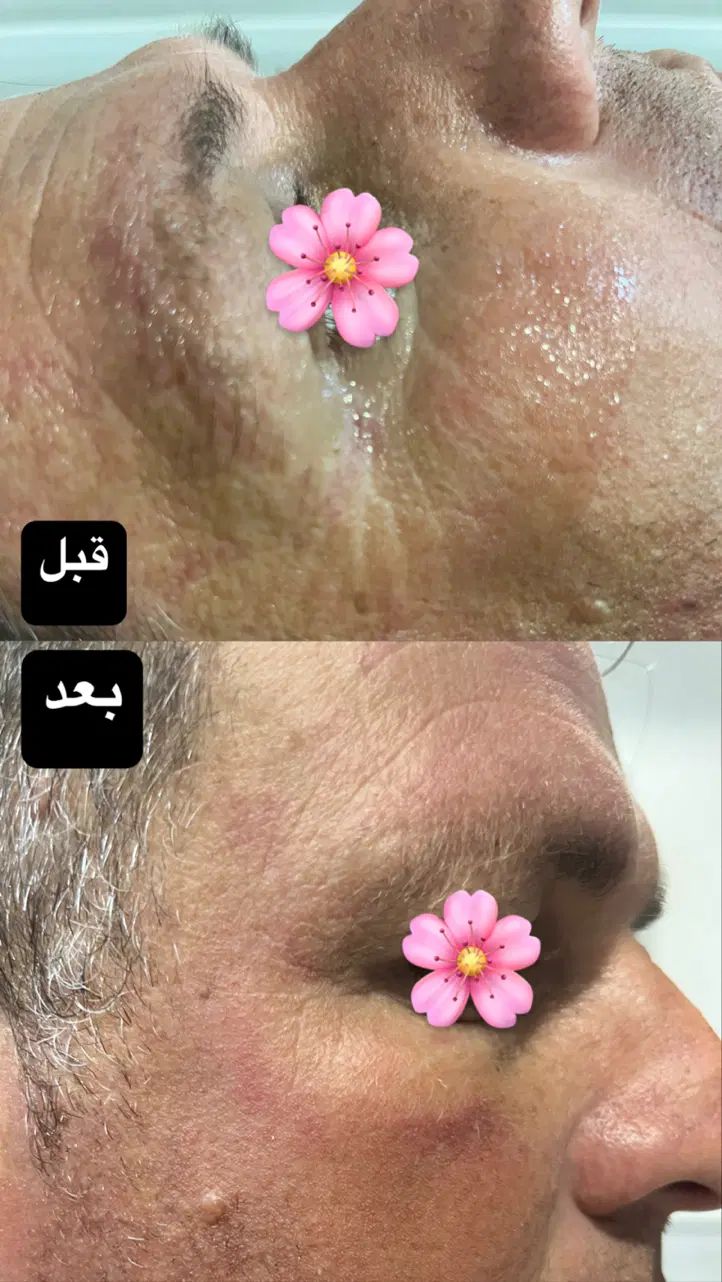 جشنواره زیبایی پوست با هایفوتراپی و آر اف فرکشنال|خدمات آرایشگری و زیبایی|قم, دورشهر|دیوار