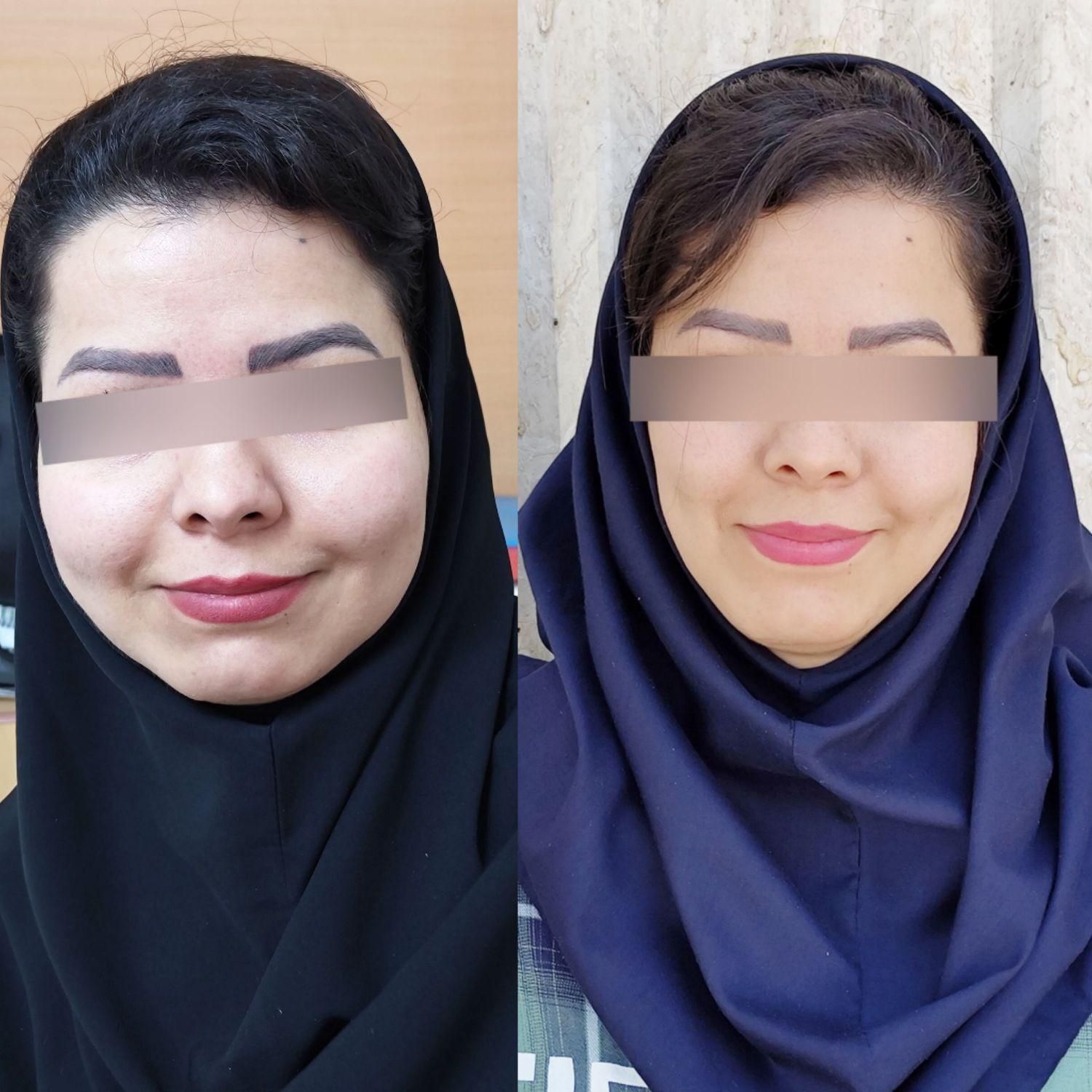 چاقی صورت (تضمینی بدون بازگشت)|آرایشی، بهداشتی، درمانی|رفسنجان, |دیوار