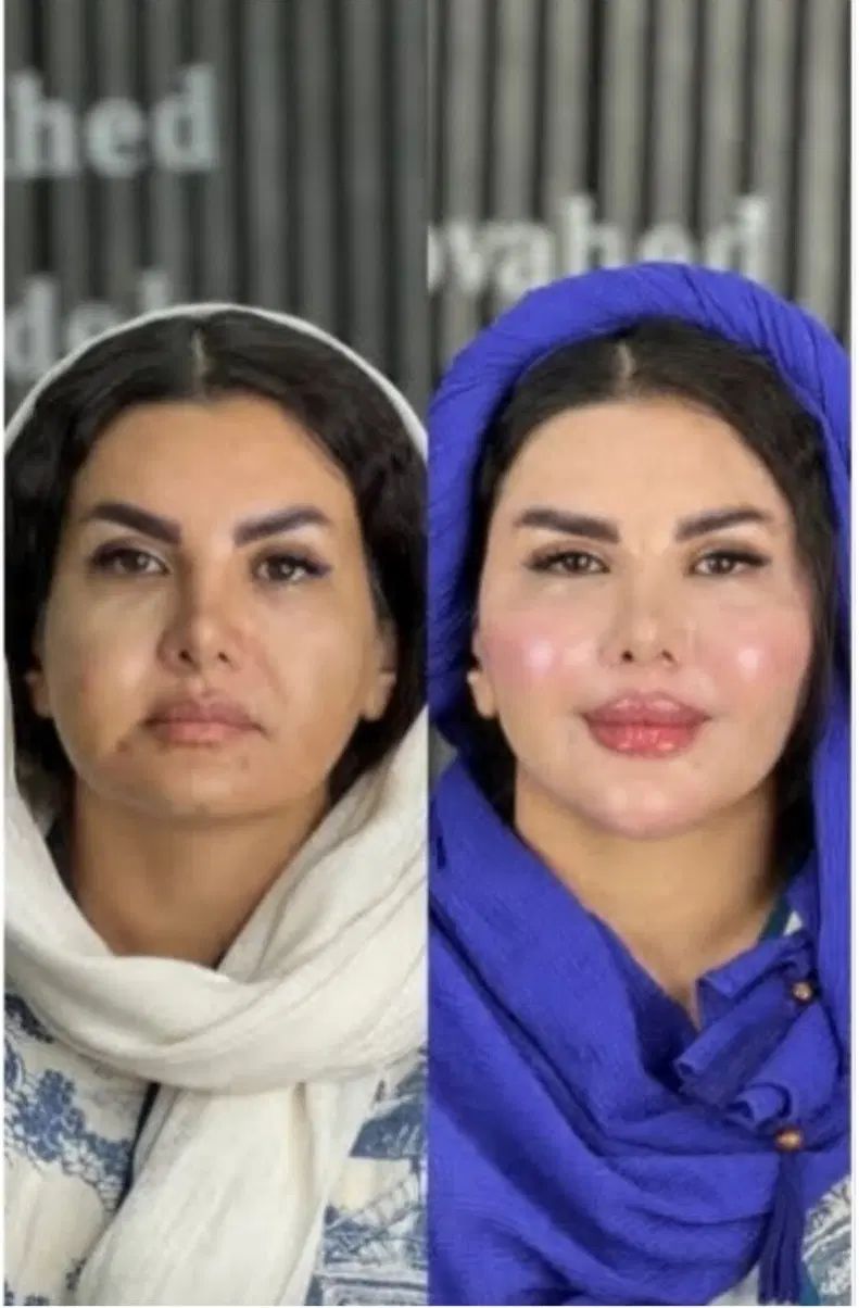 تزریق ژل لب و گونه و چانه.. (جشنواره)درمطب فقط500ت|خدمات آرایشگری و زیبایی|اصفهان, باغ زیار|دیوار