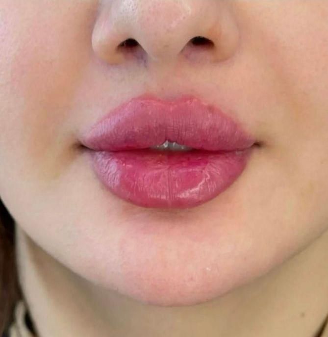 تزریق ژل لب و گونه و چانه.. (جشنواره)درمطب فقط499ت|خدمات آرایشگری و زیبایی|اصفهان, باغ زیار|دیوار
