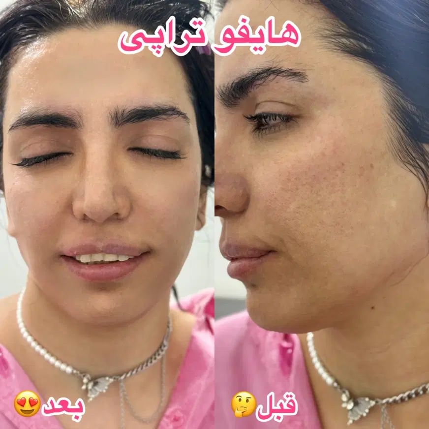 پلاژن تراپی /هایفو تراپی /لیزر بدن/کربوکسی|آرایشگاه و سالن‌های زیبایی|مشهد, کارگران|دیوار