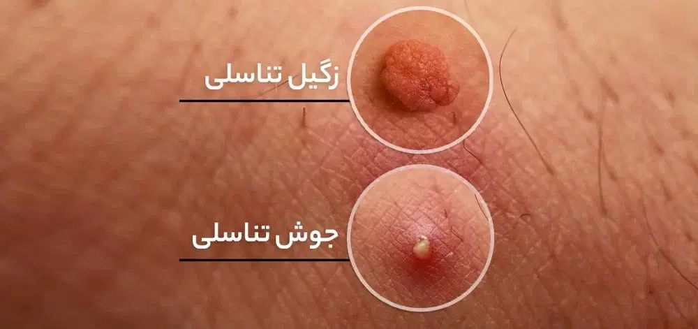 کمک به درمان زگیل تناسلی‌و..|آرایشی، بهداشتی، درمانی|مشهد, کوه سنگی|دیوار