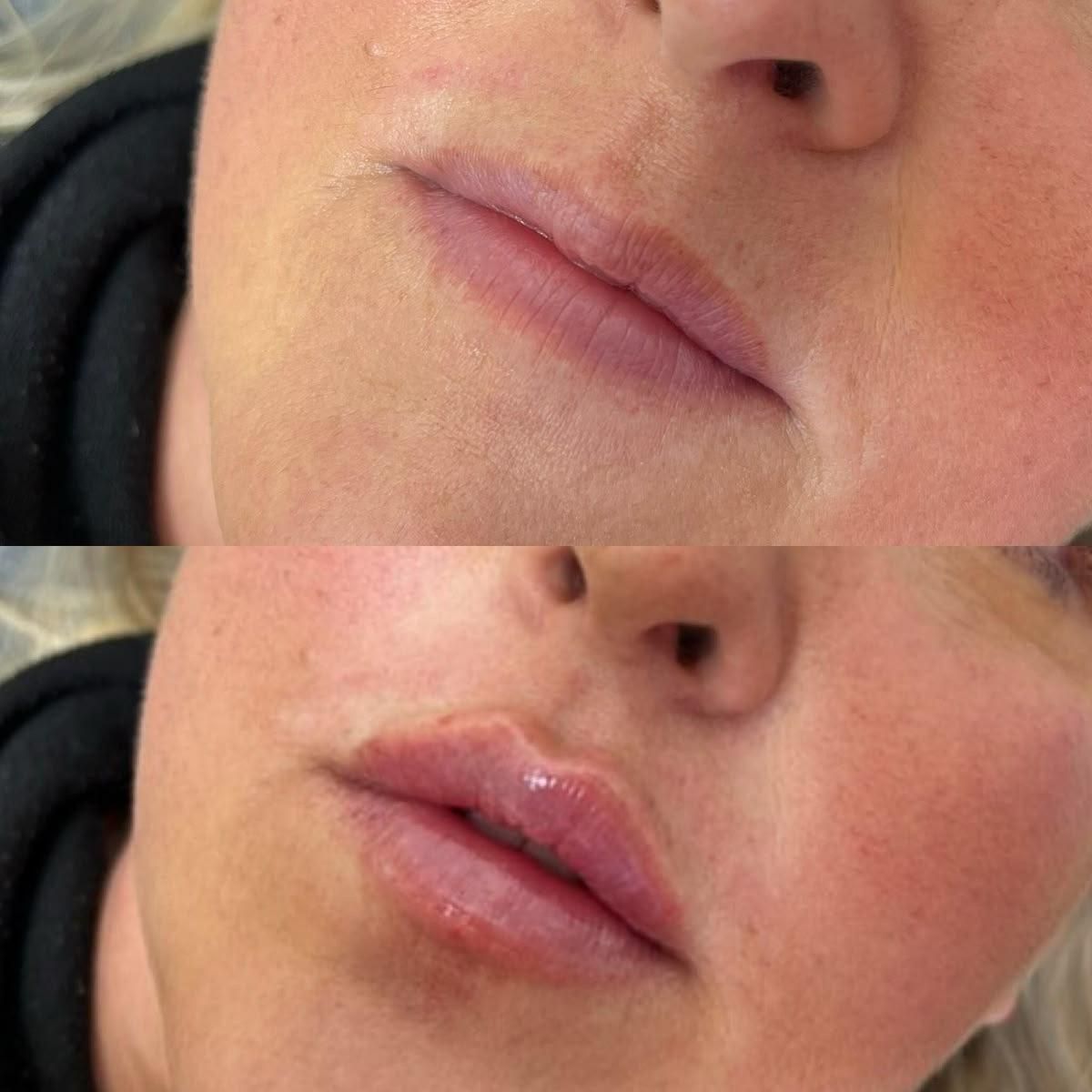 خدمات زیبایی صورت مزوتراپی بوتاکس فیلر|خدمات آرایشگری و زیبایی|شهریار, شهریار|دیوار