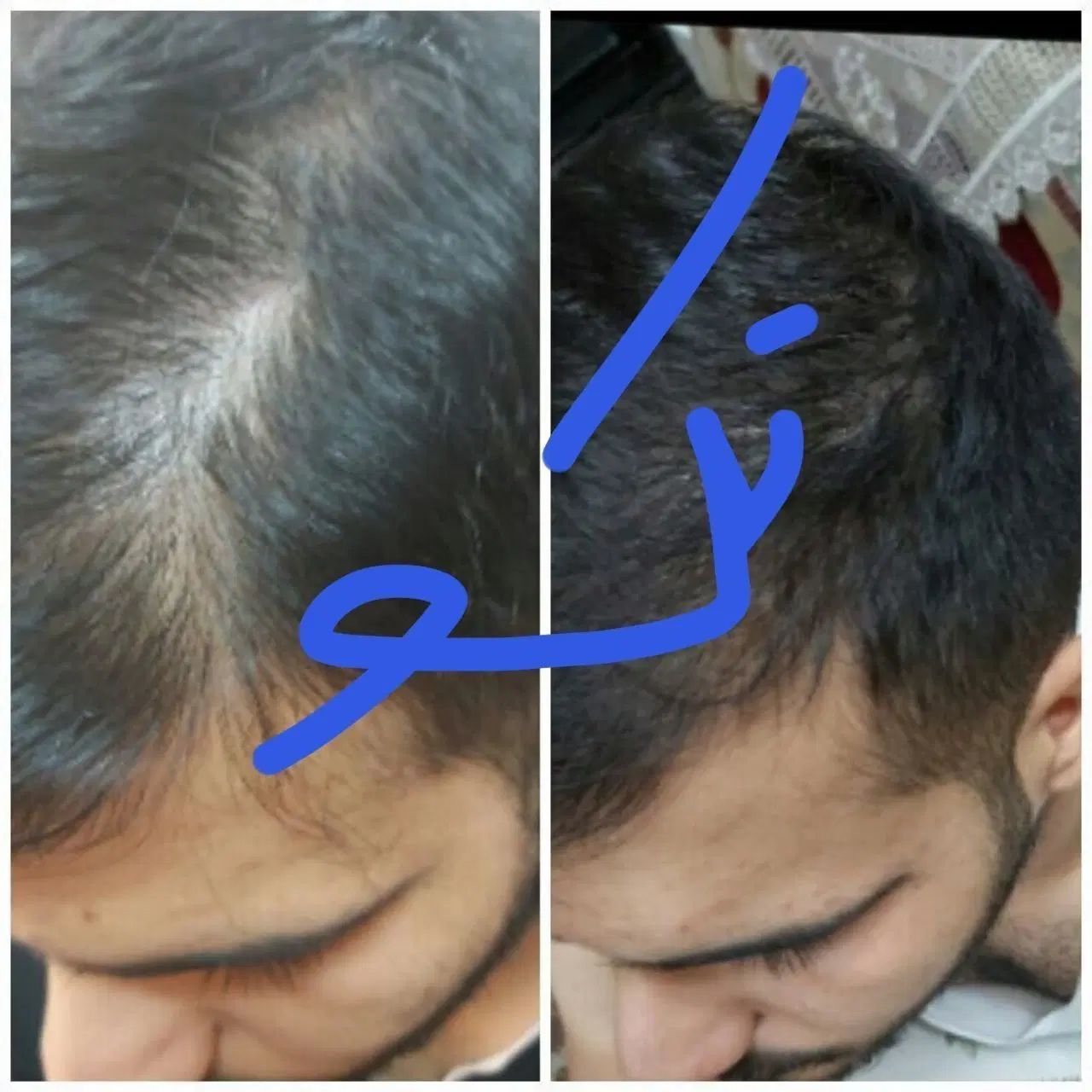 موهای بلند پرپشت داشته باشید|آرایشی، بهداشتی، درمانی|رشت, آزادگان|دیوار