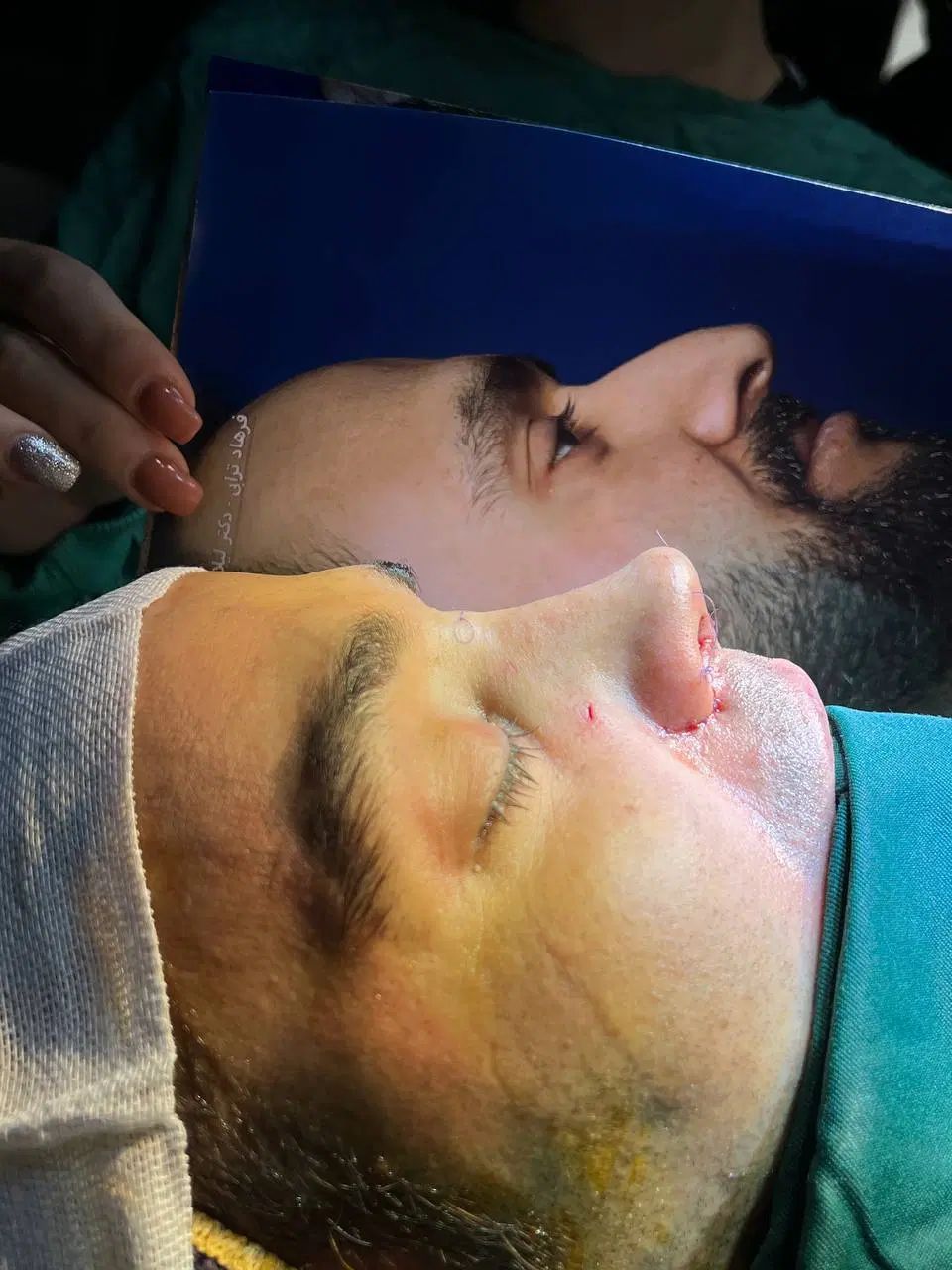 کاشت جراحی بینی غبغب سانترال دایرکت لمینت کامپوزیت|خدمات آرایشگری و زیبایی|قم, سالاریه|دیوار