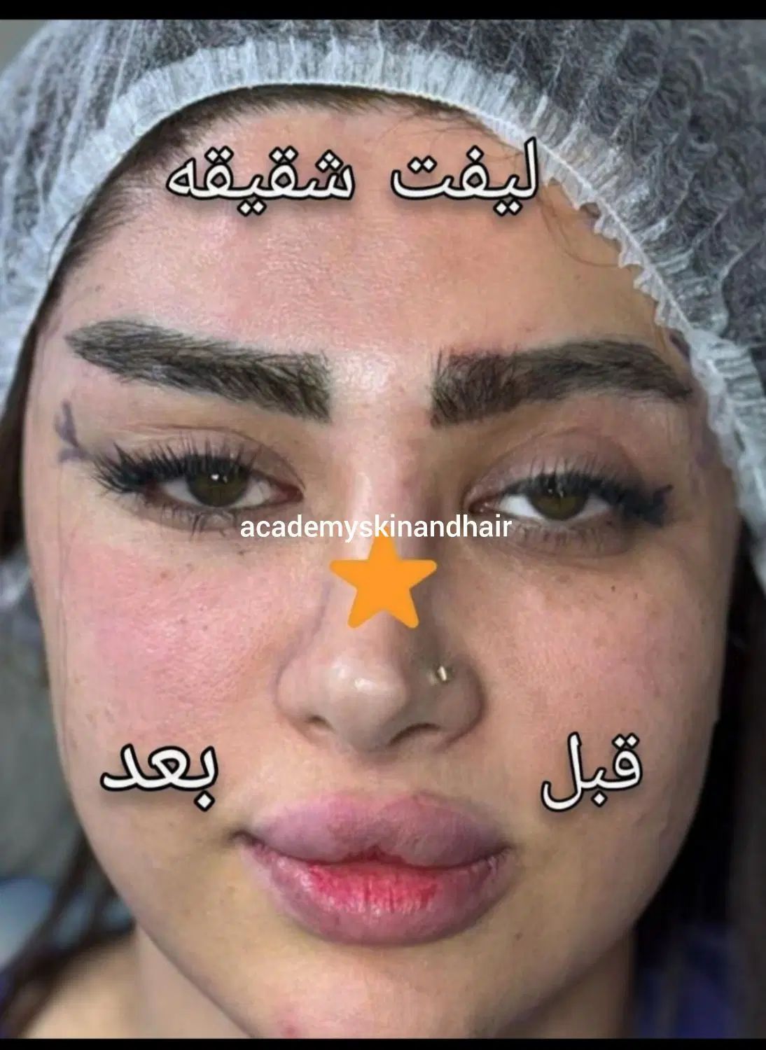 بمب تخفیف ژل ،بوتاکس،نخ وغیره فقط دوهفته لارم|خدمات آرایشگری و زیبایی|لار, |دیوار
