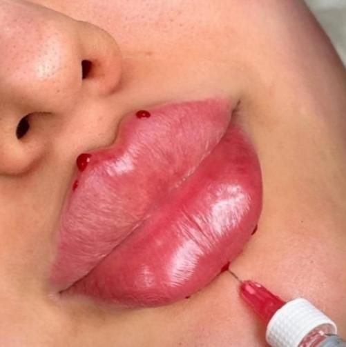 ساکشن چربی و تزریق ژل و بوتاکس و مزو لیفت شقیقه و.|خدمات آرایشگری و زیبایی|کرمانشاه, |دیوار