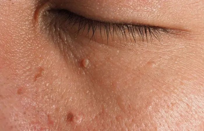 حذف فوری خال منگوله ای|آرایشی، بهداشتی، درمانی|رشت, علی آباد|دیوار