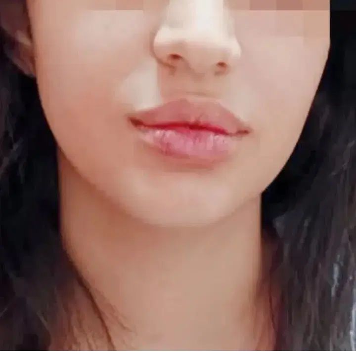 تزریق ژل وبوتاکس ژل لب گونه چانه زاویه خط لبخند|خدمات آرایشگری و زیبایی|کرمانشاه, |دیوار