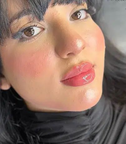 مدل تزریق فیلر برای محتوای اینستا توسط پزشک|خدمات آرایشگری و زیبایی|شاهین‌شهر, فردوسی|دیوار