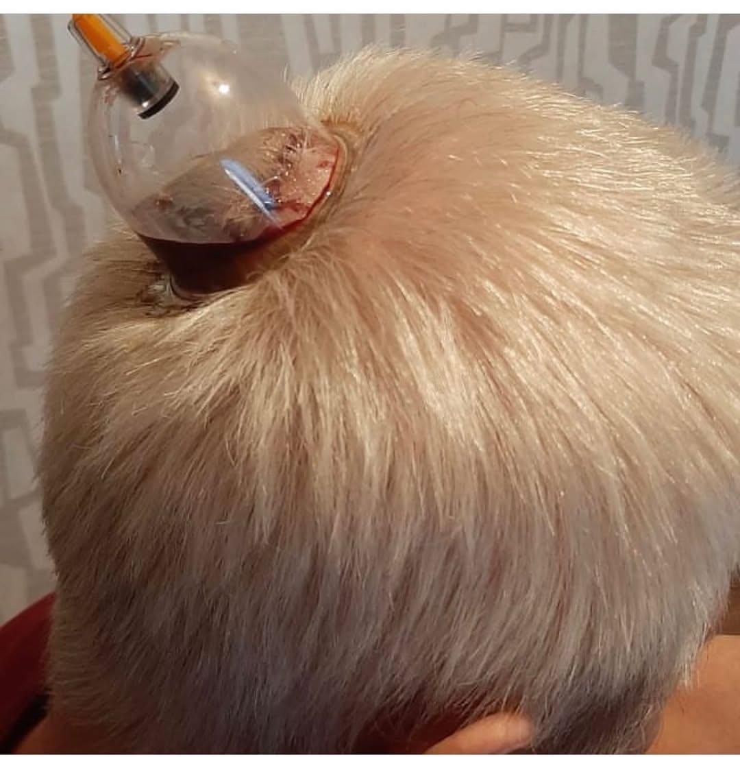 حجامت، درمان چسبندگی عصب دست، کبد چرب|خدمات آرایشگری و زیبایی|زاهدان, |دیوار