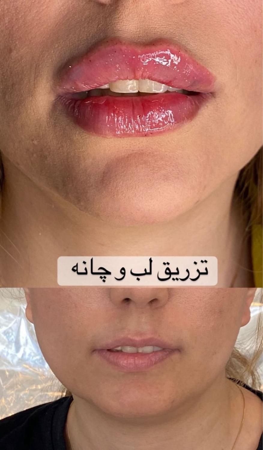 جشنواره تزریق ژل بوتاکس(قیمت پایین کیفیت بالا)|خدمات آرایشگری و زیبایی|اصفهان, جلفا|دیوار