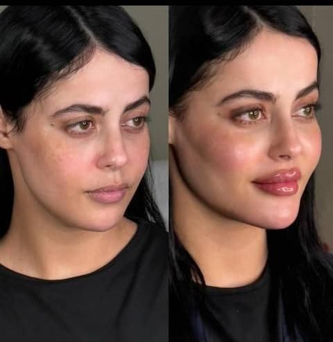 کلینیک تزریق ژل و بوتاکس .فیلر زیر چشم . آنزیم|خدمات آرایشگری و زیبایی|کرج, گوهردشت|دیوار