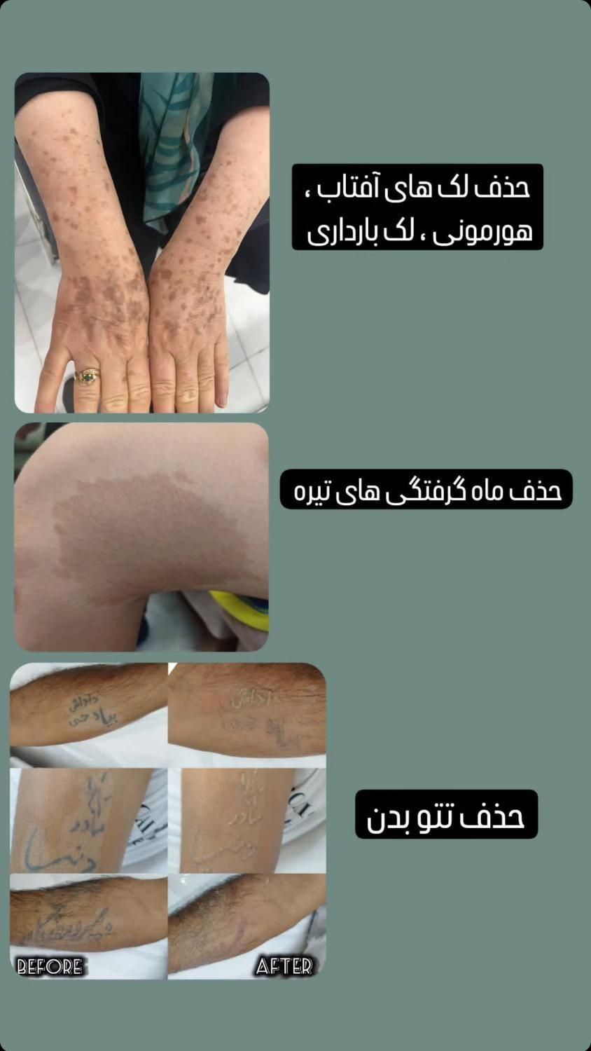 ریمو تتو وکک و مک با کیوسوییچ در کلینیک توسط پزشک|خدمات آرایشگری و زیبایی|قم, بکایی|دیوار
