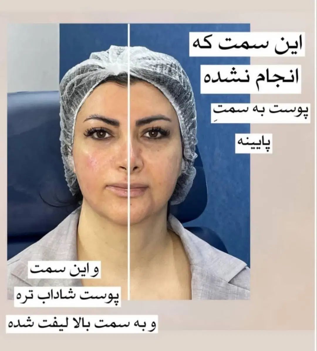 هایفوتراپی جوانسازی پوست بادستگاه ۱۲بعدی|خدمات آرایشگری و زیبایی|کرمانشاه, |دیوار