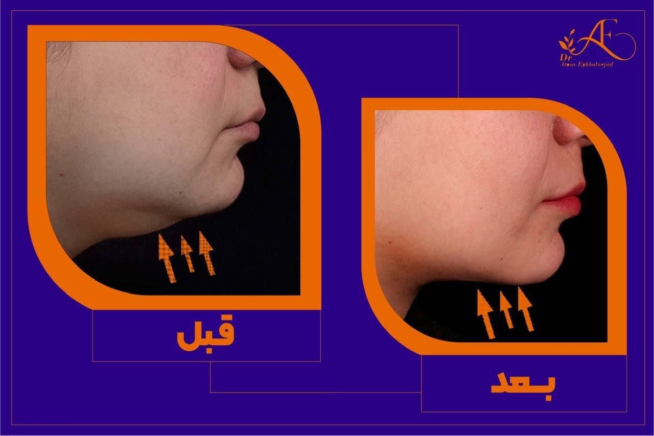 لاغری موضعی بدون جراحی و رژیم سخت|خدمات آرایشگری و زیبایی|اصفهان, سعادت‌آباد|دیوار