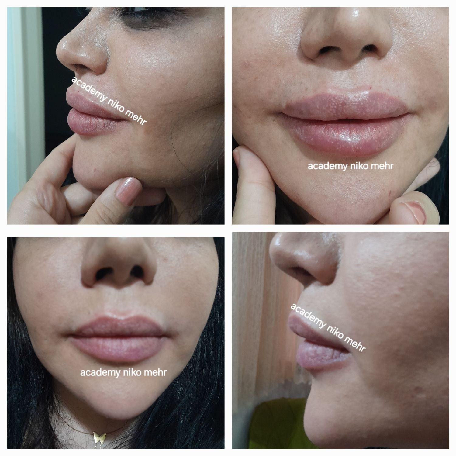 مدل بوتاکس ژل مزوتراپی میکرونیدلینگ فشیال|خدمات آرایشگری و زیبایی|فردیس, طالقانی|دیوار