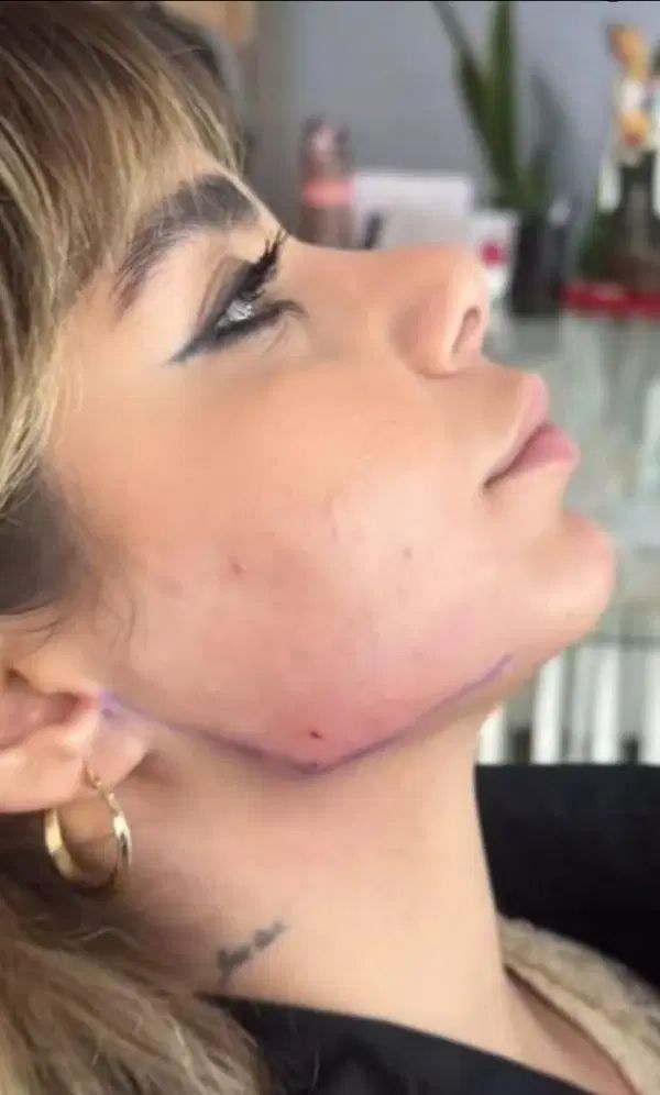 تزریق ژل بوتاکس و ساکشن تزریق چربی درکلینیک|خدمات آرایشگری و زیبایی|کرمانشاه, |دیوار