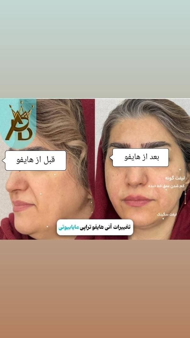 جوانسازی قوی  لیفت صورت ،روشن کننده هایفوتراپی|خدمات آرایشگری و زیبایی|یاسوج, |دیوار