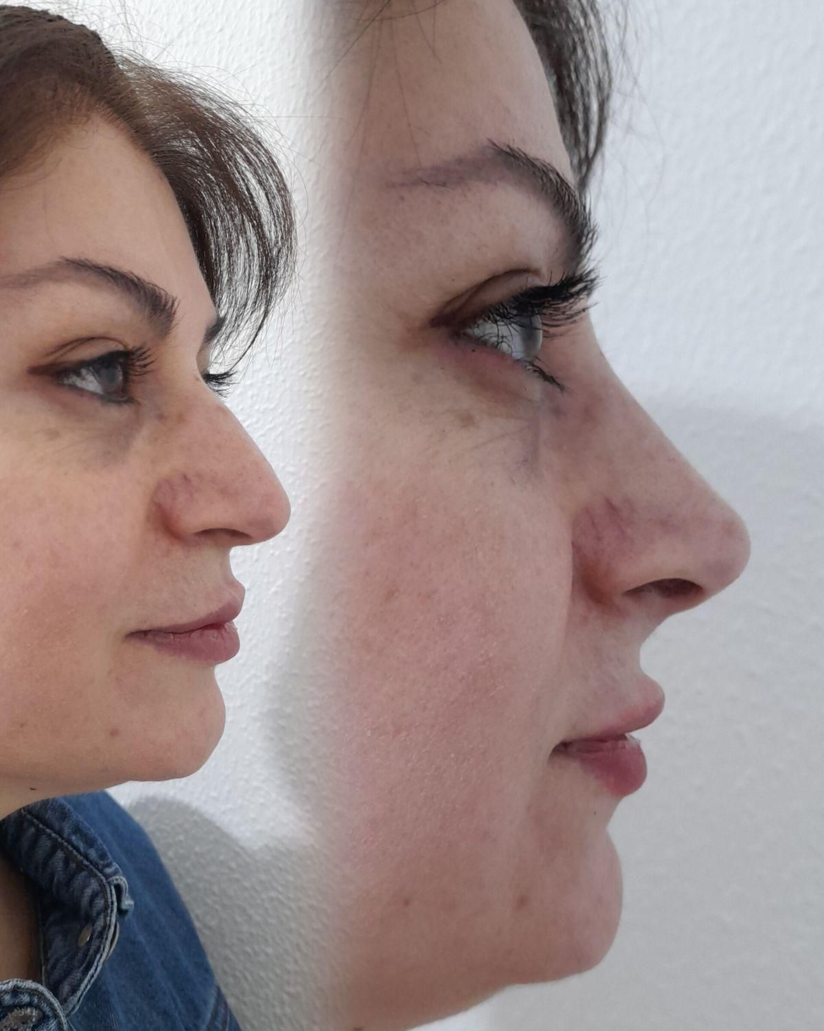 اصلاح قوز و افتادگی بینی بدون جراحی در مطب20%تخفیف|خدمات آرایشگری و زیبایی|شاهین‌شهر, فردوسی|دیوار