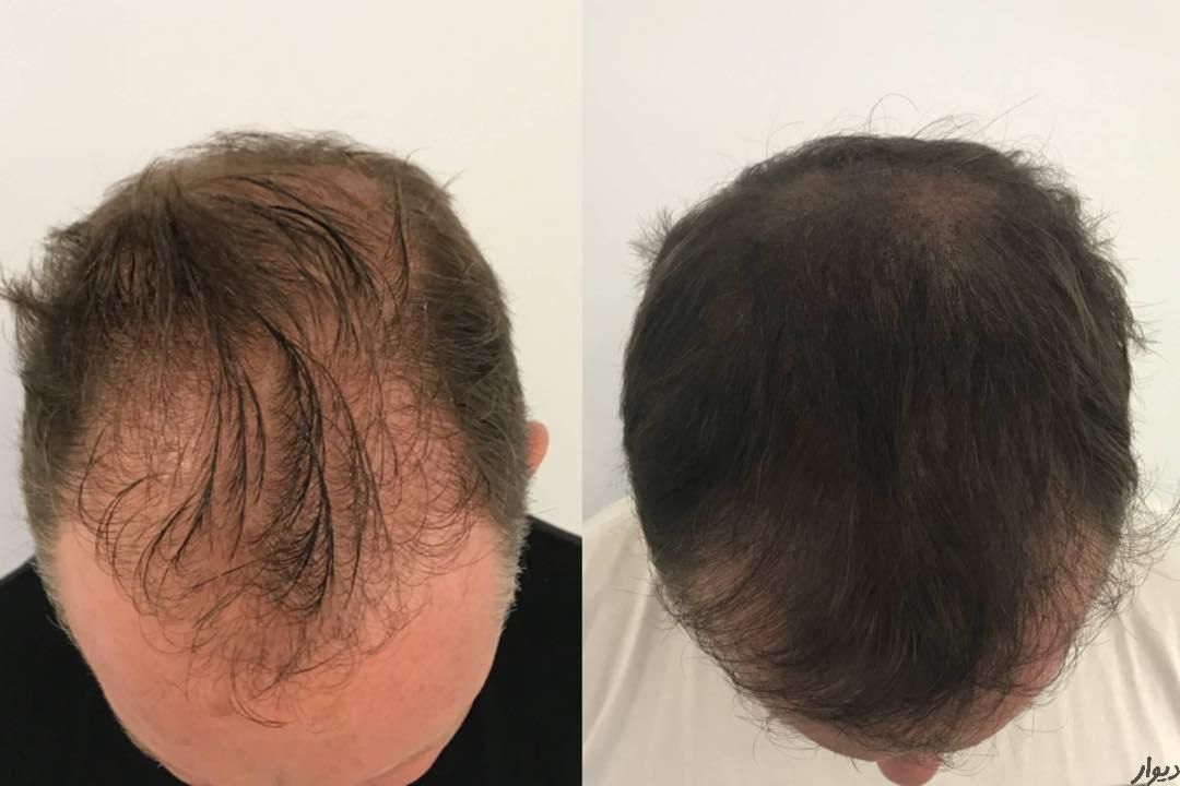 میکرواسکالپ / اسکالپ جایگزین کاشت مو تضمینی|خدمات آرایشگری و زیبایی|مشهد, شهید فرامرز عباسی|دیوار