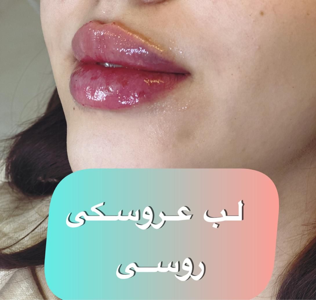 اموزش فیلر و بوتاکس و مزوتراپی و پی ار پی|خدمات آموزشی|مشهد, هنرستان|دیوار