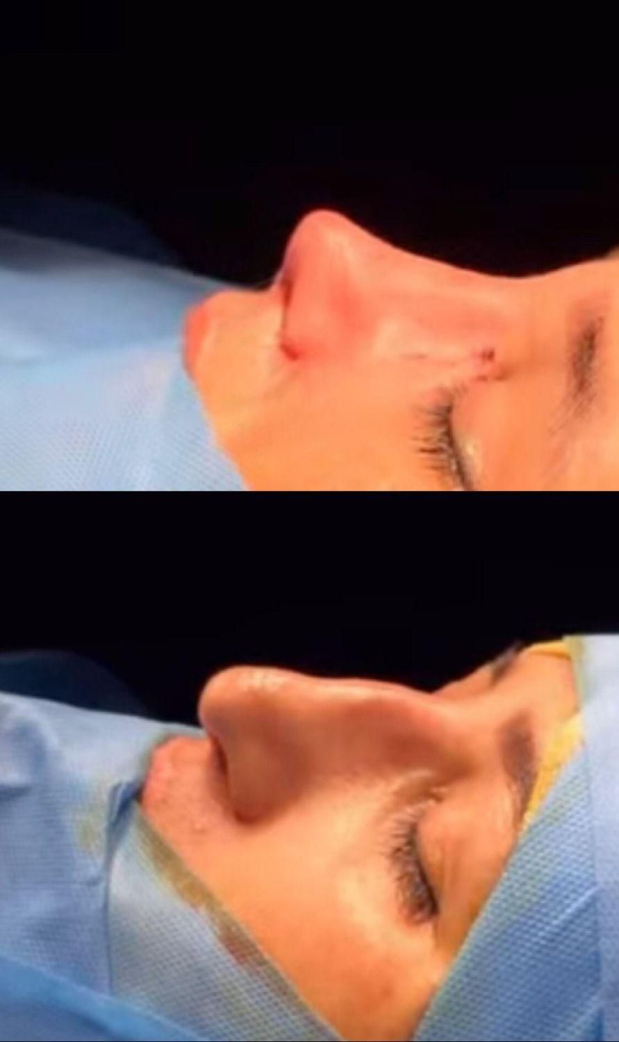 جراحی بینی با تخفیف استثنایی به مدت ۱۰روز|خدمات آرایشگری و زیبایی|بندرعباس, |دیوار