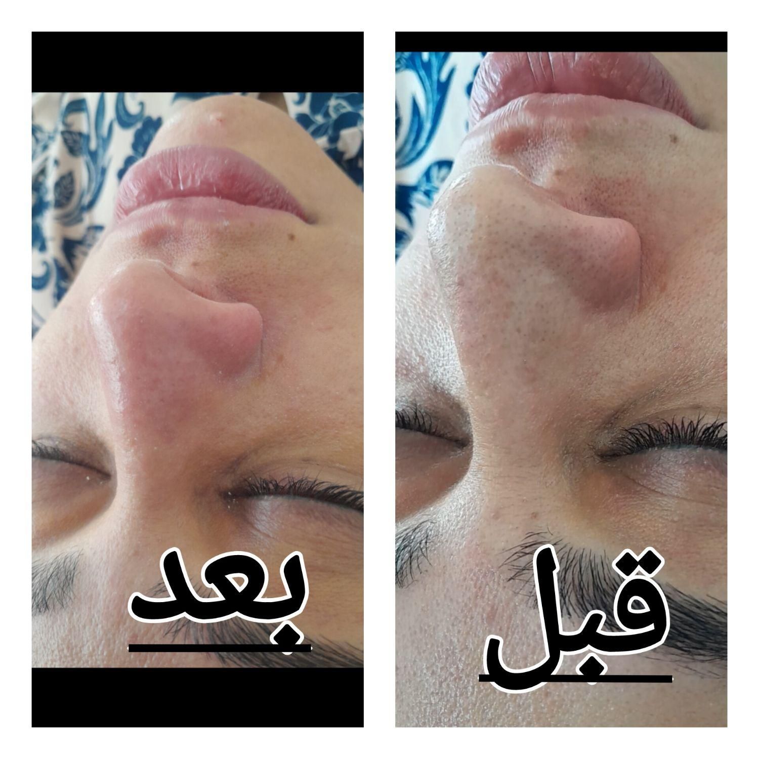%30 تخفیف فیشال تخصصی پلاژن کربوسی اسیدومزونیدلینگ|خدمات آرایشگری و زیبایی|اهواز, کوی باهنر|دیوار