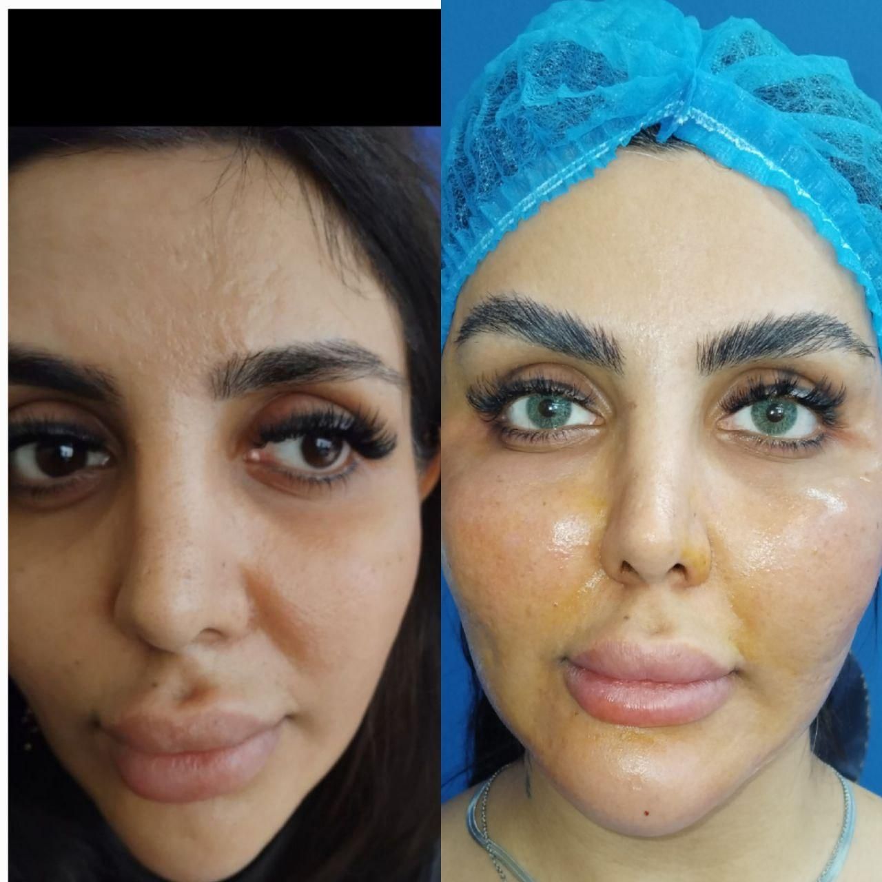 مرکز تخصصی تزریق چربی/فیلرلب و صورت/نخ لیفت/بوتاکس|خدمات آرایشگری و زیبایی|مشهد, سجاد شهر|دیوار