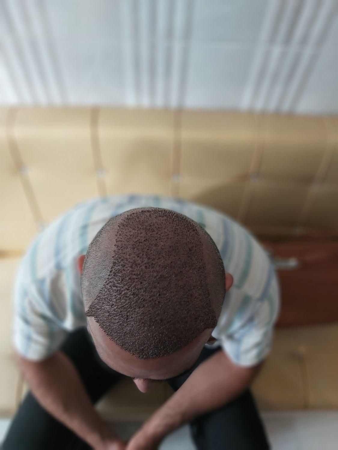 کاشت موی تخصصی و تضمینی|خدمات آرایشگری و زیبایی|تبریز, |دیوار