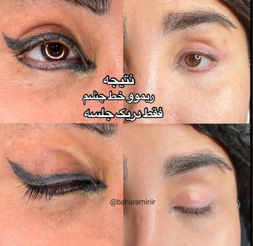 ریموو  هر نوع تتویی  کاملا تضمینی اف خورده|خدمات آرایشگری و زیبایی|کرمانشاه, |دیوار