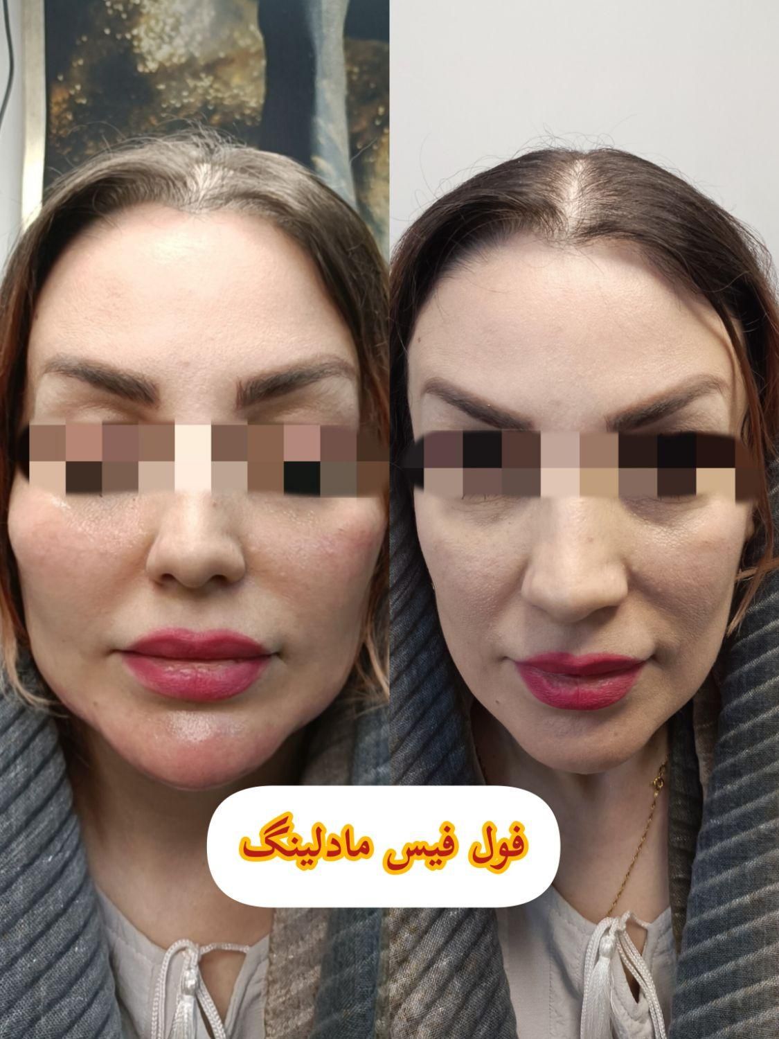 جشنواره تخفیف بوتاکس/ژل/آنزیم‌بینی/فیلرلب/فولفیس|خدمات آرایشگری و زیبایی|شیراز, زرهی|دیوار