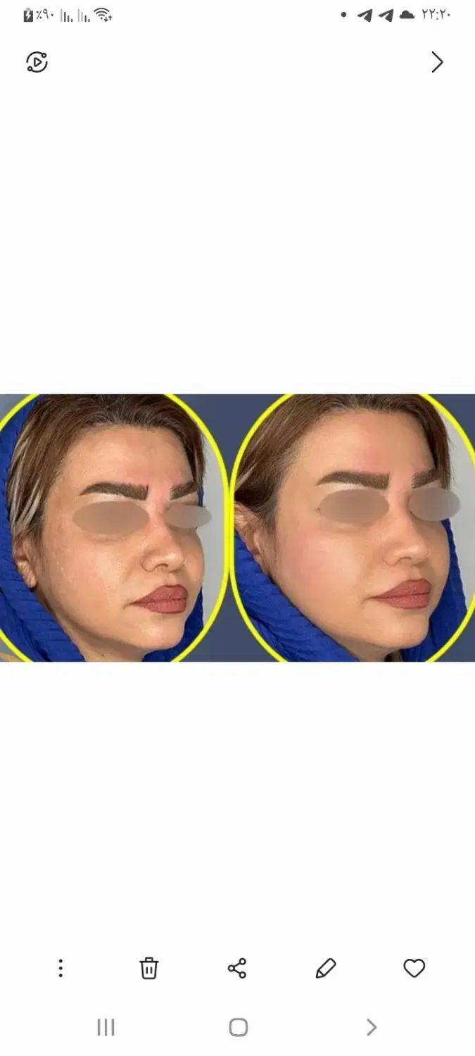 جشنواره تززیق فیلر،ژل وبوتاکس درهفده شهریور|خدمات آرایشگری و زیبایی|تبریز, |دیوار