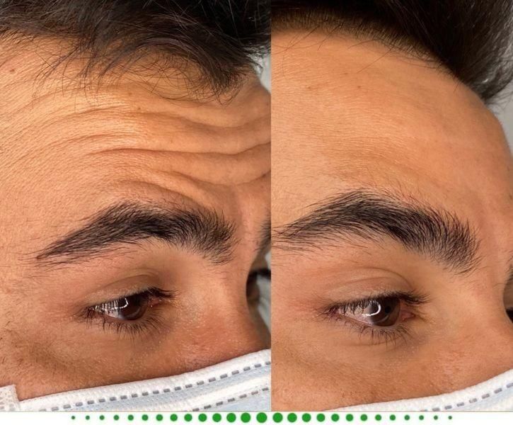 جشنواره بوتاکس وفیلر|خدمات آرایشگری و زیبایی|گلستان (تهران), |دیوار