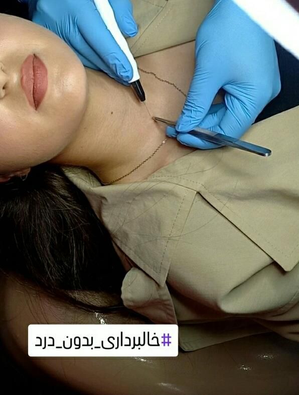 لیزر موهای زائد، ریمو تتو، خالبرداری زگیل میخچه|خدمات آرایشگری و زیبایی|ارومیه, |دیوار