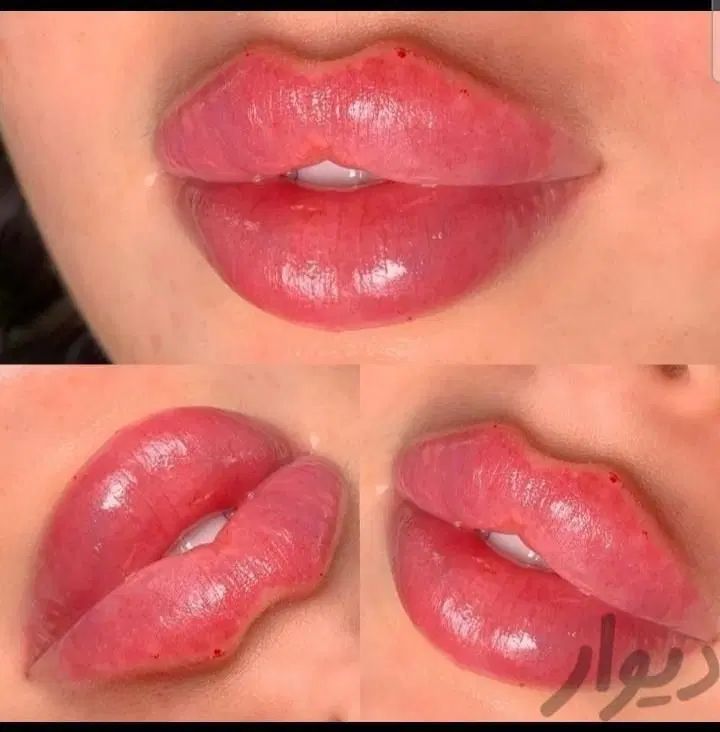 کلینیک تزریق ژل بوتاکس آنزیم فیلر لب شقیقه|خدمات آرایشگری و زیبایی|کرج, گوهردشت|دیوار