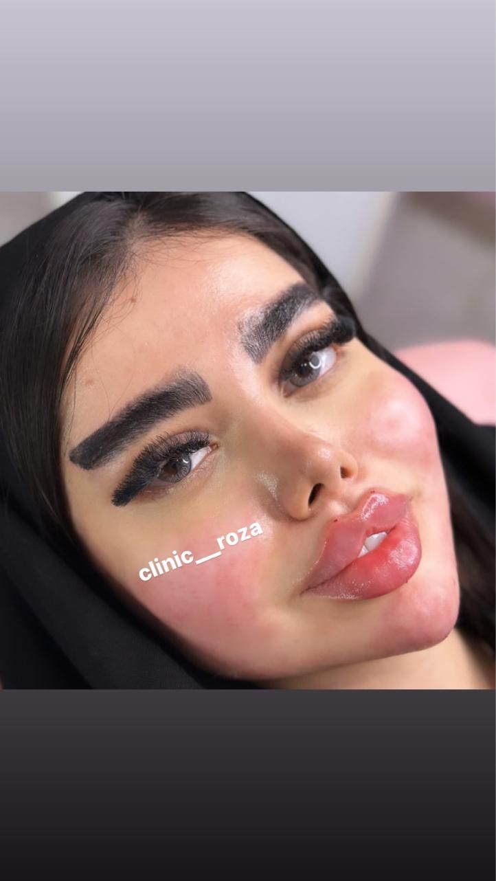 مدل تزریق ژل فیلر کانتورینگ عربی لب روسی|خدمات آرایشگری و زیبایی|کرج, گوهردشت|دیوار