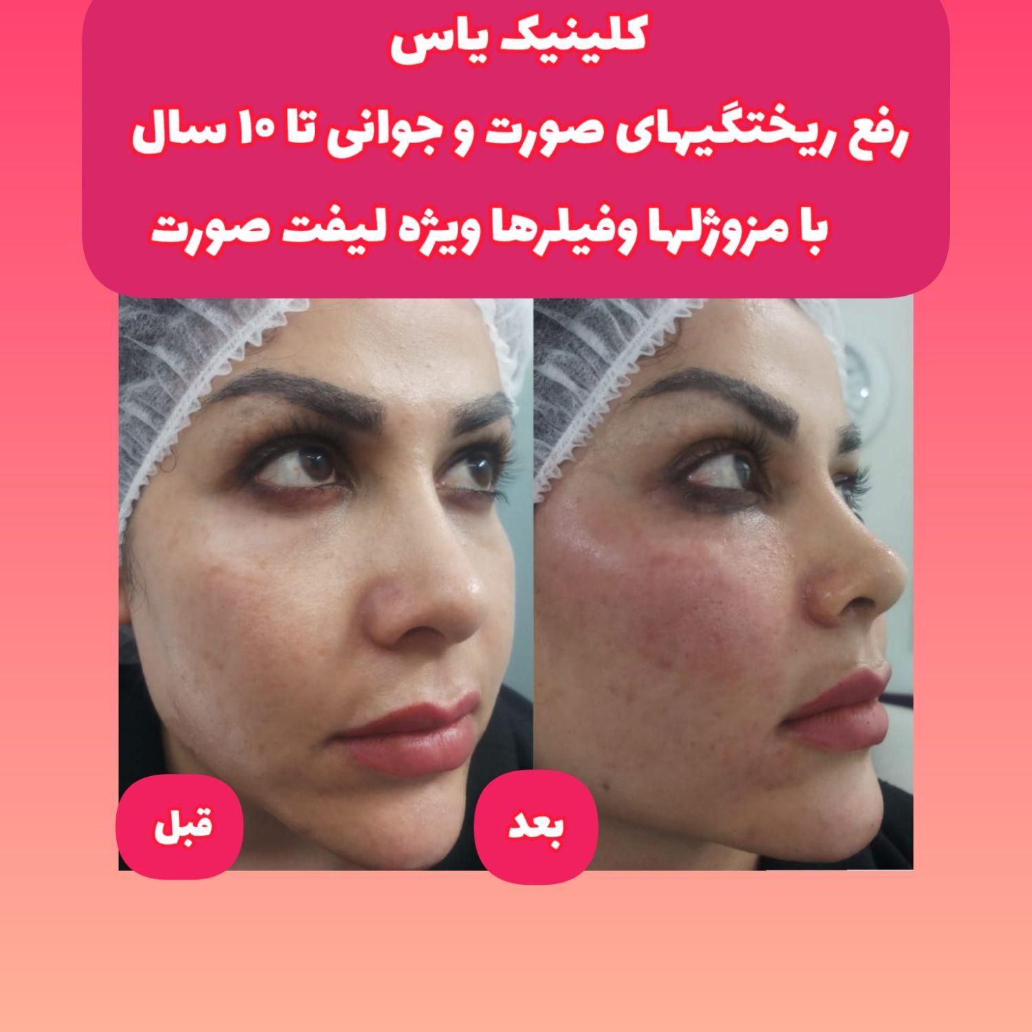 ژل بوتاکس ۳۹۰/ فیلربینی زیرچشم/لیفت صورت شقیقه/نخ|خدمات آرایشگری و زیبایی|تهران, فدک|دیوار