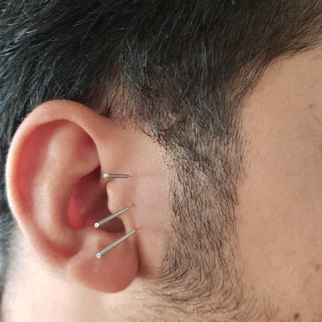 حجامت بادکش امبدینگ طب سوزنی زگیل تناسلی hpv|خدمات آرایشگری و زیبایی|اصفهان, جاوان|دیوار