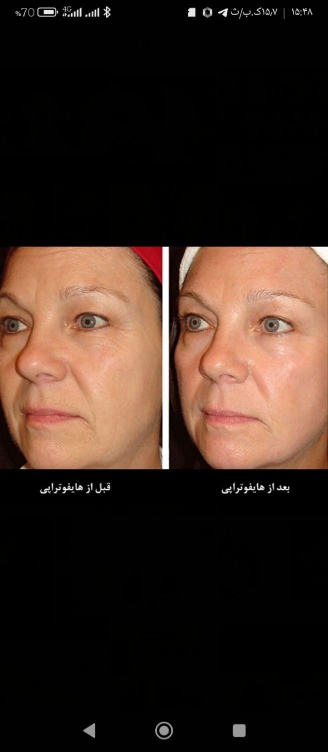 هایفوتراپی صورت و غبغب و شکم|خدمات آرایشگری و زیبایی|تبریز, |دیوار