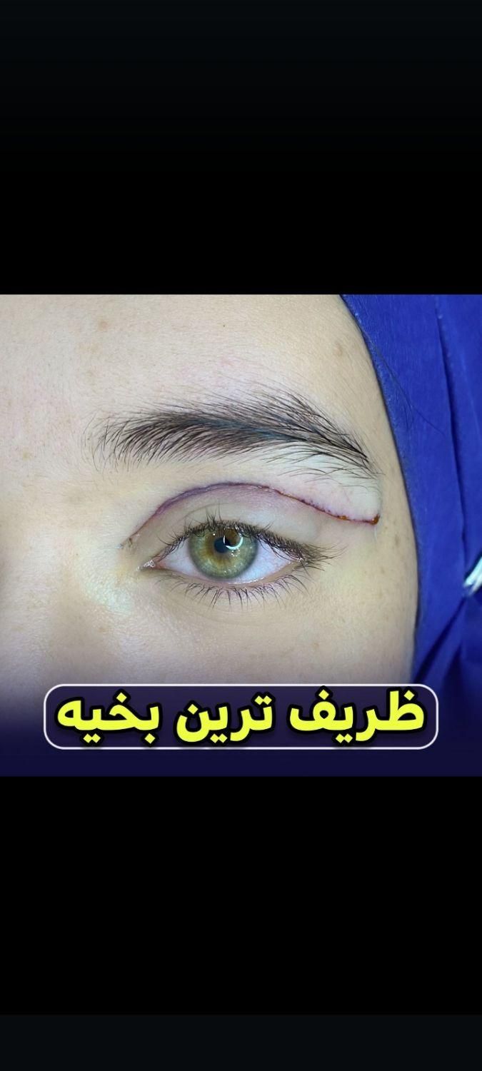 لیپو ابدو کاشت مو ابرو تزریق چربی ژل بوتاکس بلفارو|خدمات آرایشگری و زیبایی|اهواز, نادری|دیوار